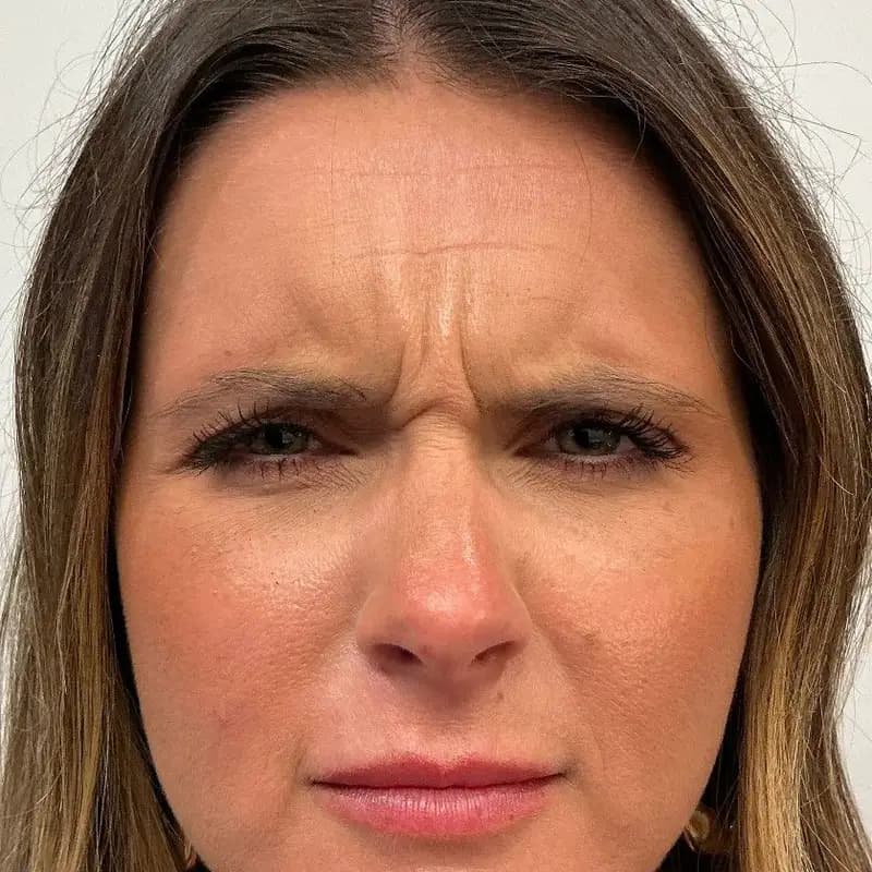 Frown lines before Botox treatment, front view