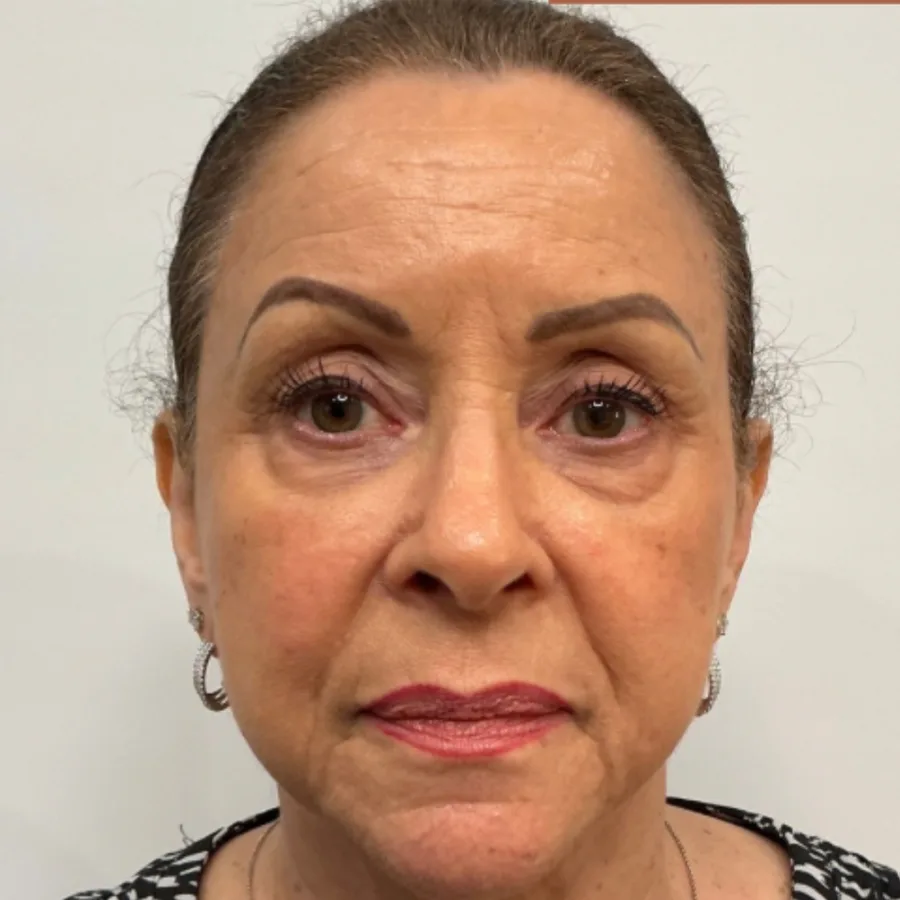 Filler & Biostimulation — face before and after filler and biostimulation, before