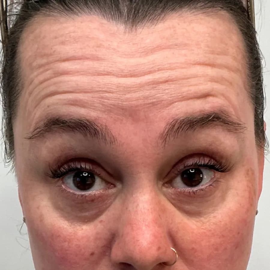 Botox — patient before and after Botox, before