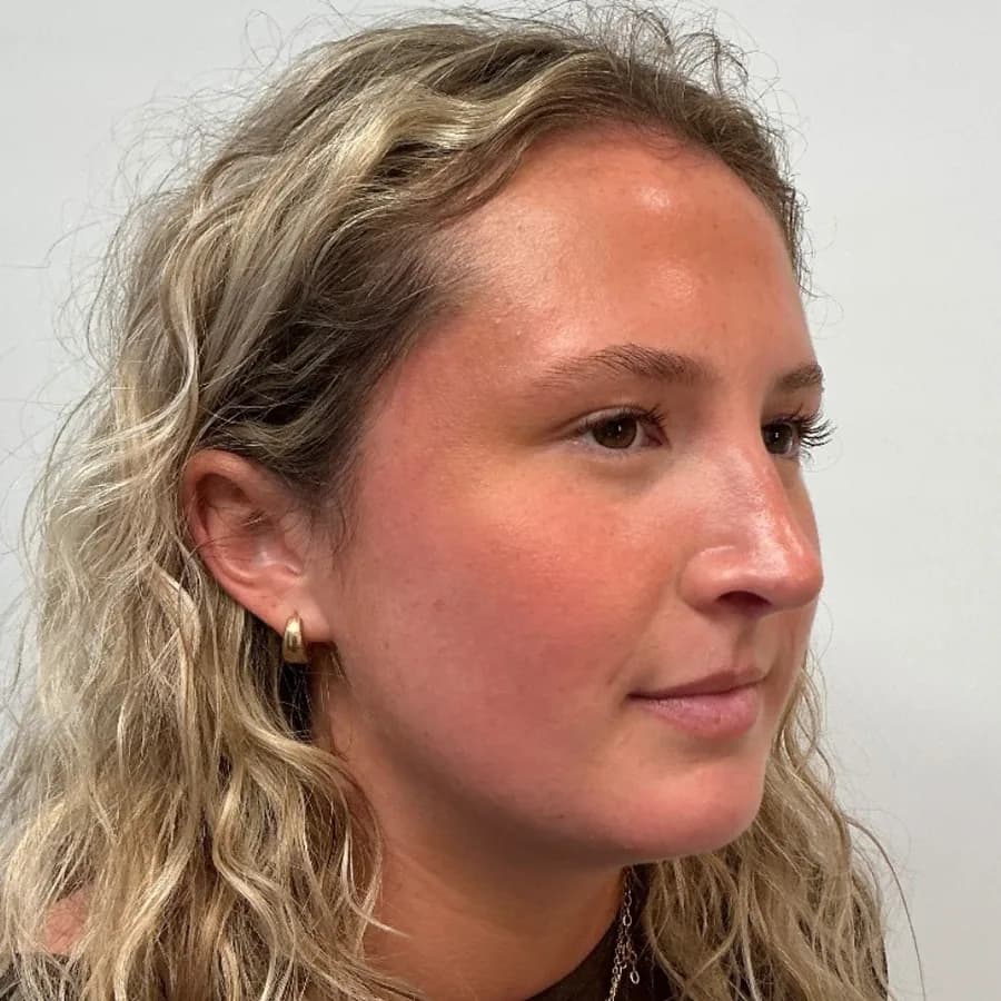 Lip Filler — lips before and after filler, before
