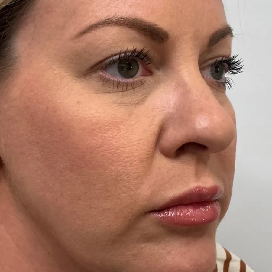 Lip Filler — lips before and after filler, before