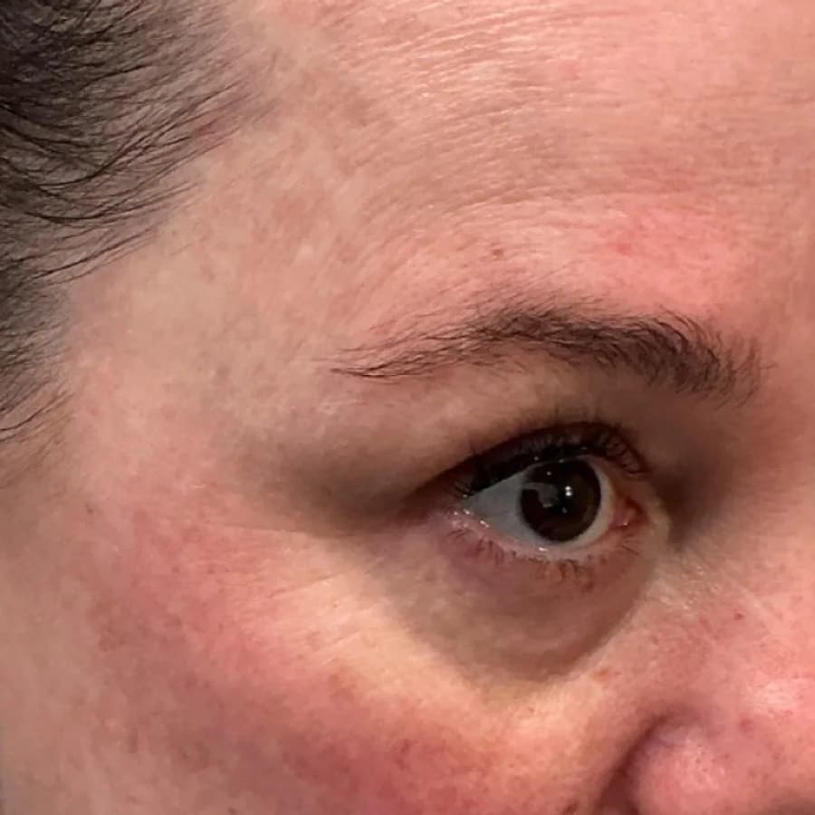 Undereye Filler — undereye area before and after filler, before