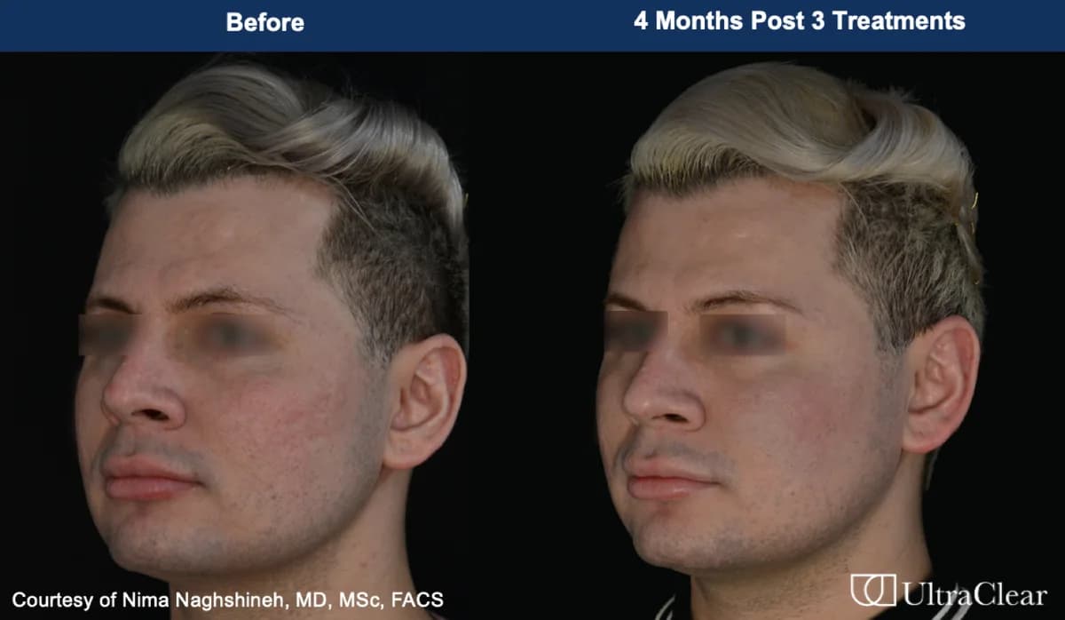 UltraClear before and after — 4 months post 3 treatments. Courtesy of Nima Naghshineh, MD, MSc, FACS.