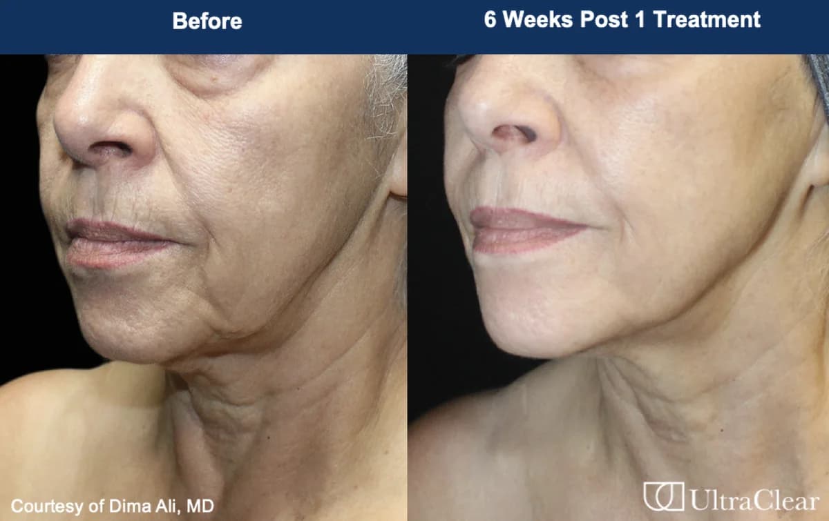 UltraClear before and after — 6 weeks post 1 treatment. Courtesy of Dima Ali, MD.