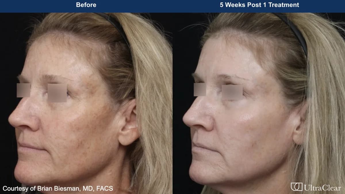 UltraClear before and after — 5 weeks post 1 treatment. Courtesy of Brian Biesman, MD, FACS.
