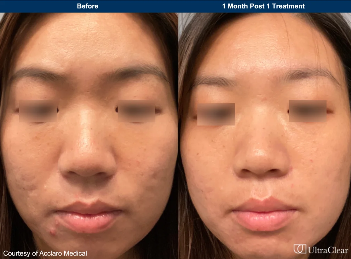 UltraClear before and after — 1 month post 1 treatment. Courtesy of Acclaro Medical.