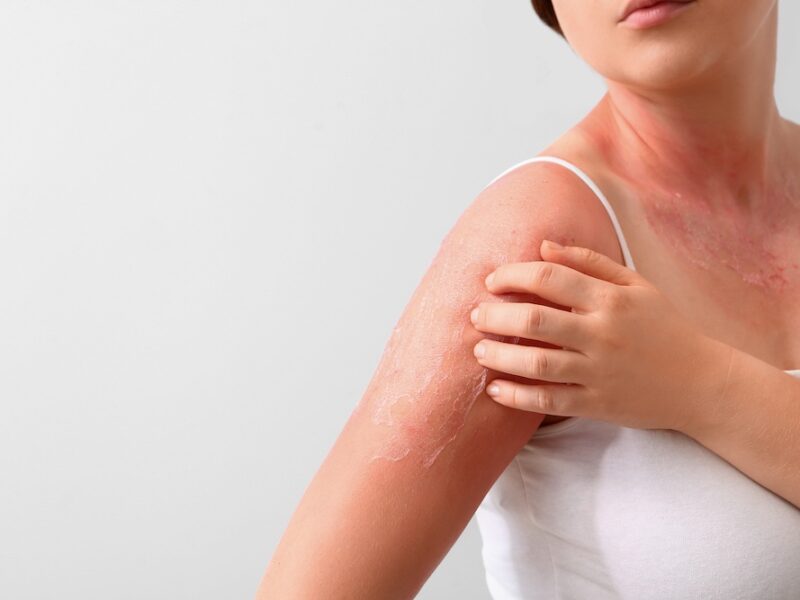 Best Med Spa Treatments in Bluffton for Sun-Damaged Skin