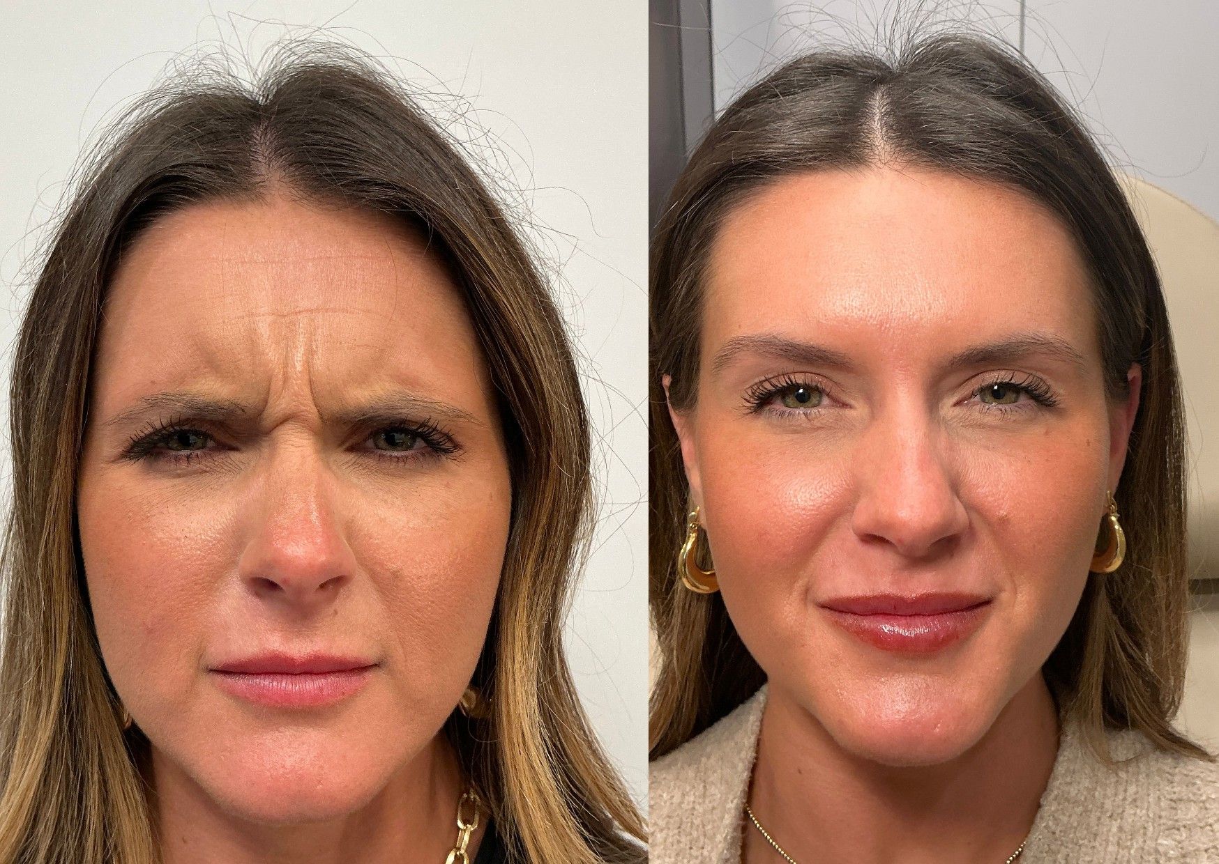 Before — Botox Before and After at The Bluffs Med Spa Bluffton SC