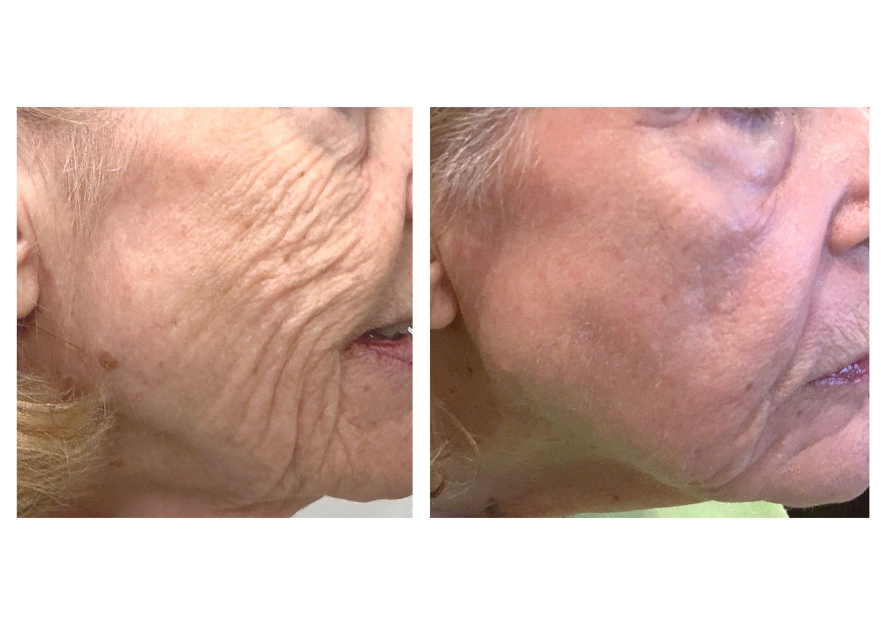 Before — Laser Treatment Before and After at The Bluffs Med Spa Bluffton SC